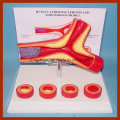 Menschliche Arterie Atherosklerose und Thrombose Modell